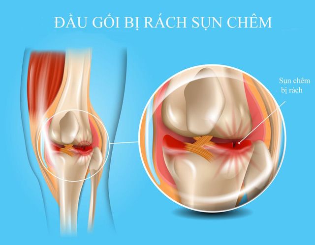 Điểm mặt một số nguyên nhân gây đau khớp gối - Ảnh 7.