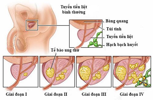 Ung thư tuyến tiền liệt những điều cần biết và hiểu lầm thường gặp - Ảnh 1.